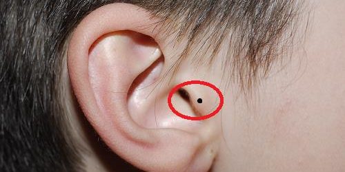 Vị trí nốt ruồi ở tai nam giới có ý nghĩa như thế nào?
